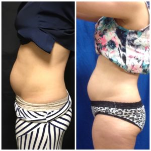 Nina before and 3 months after the one recommended Sculpsure treatment. 